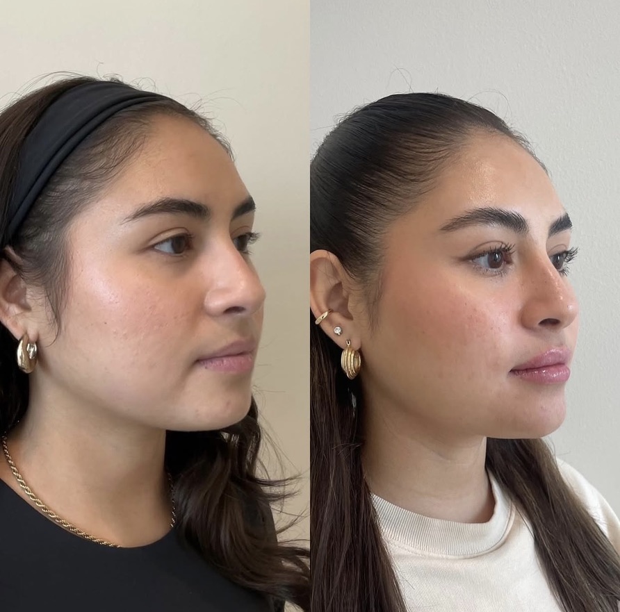 Caso de harmonização facial 5