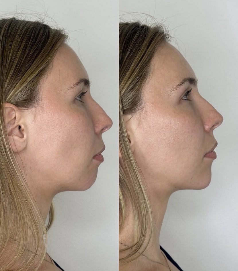 Caso de harmonização facial 4
