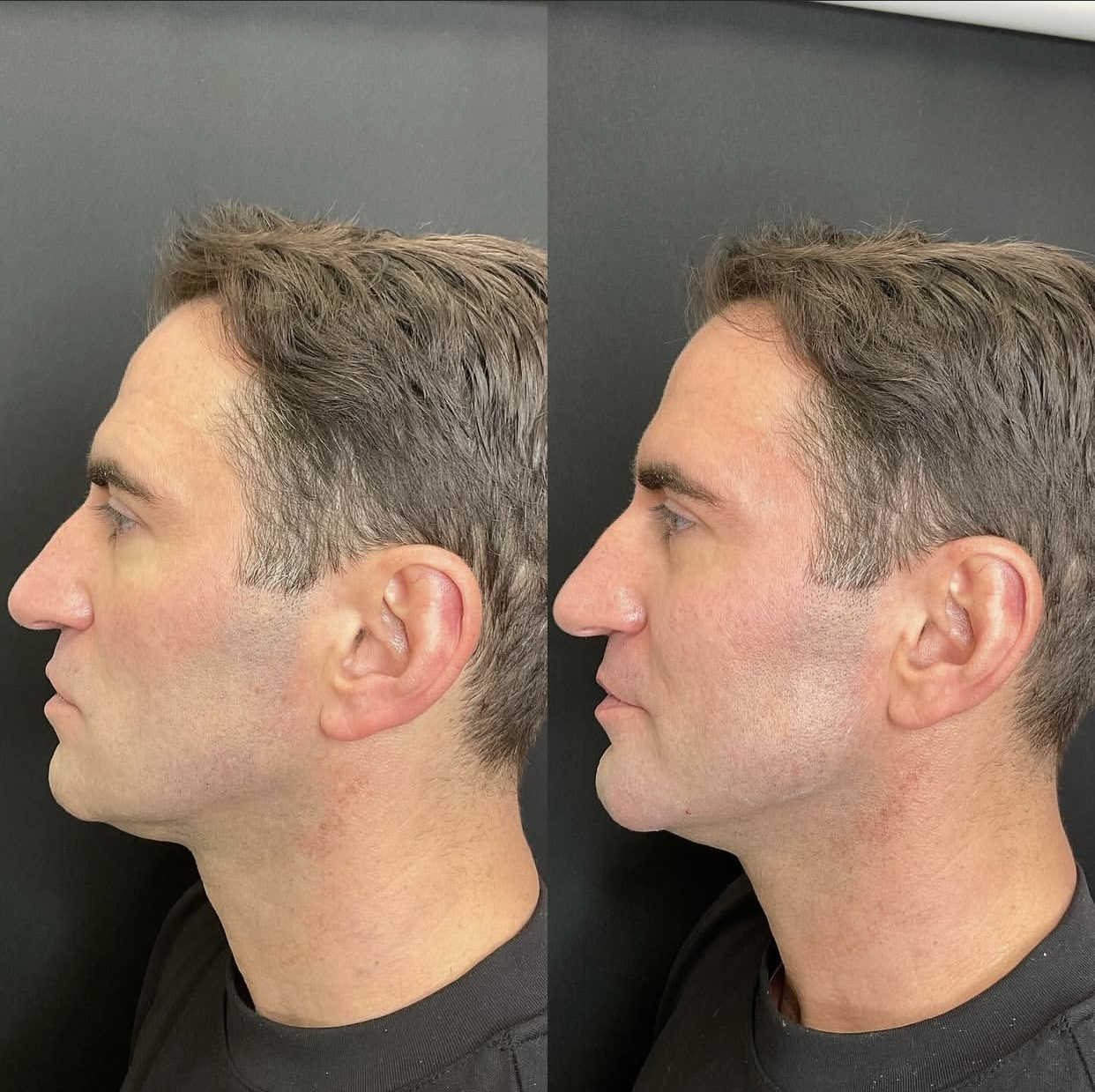 Caso de harmonização facial 2