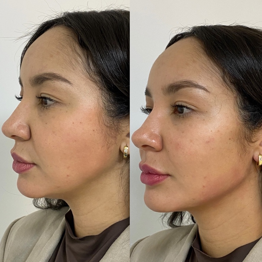 Caso de harmonização facial 3