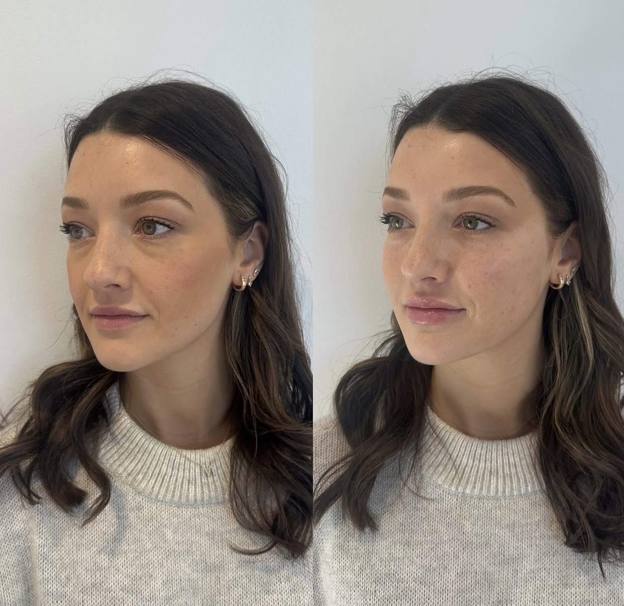 Caso de harmonização facial 1