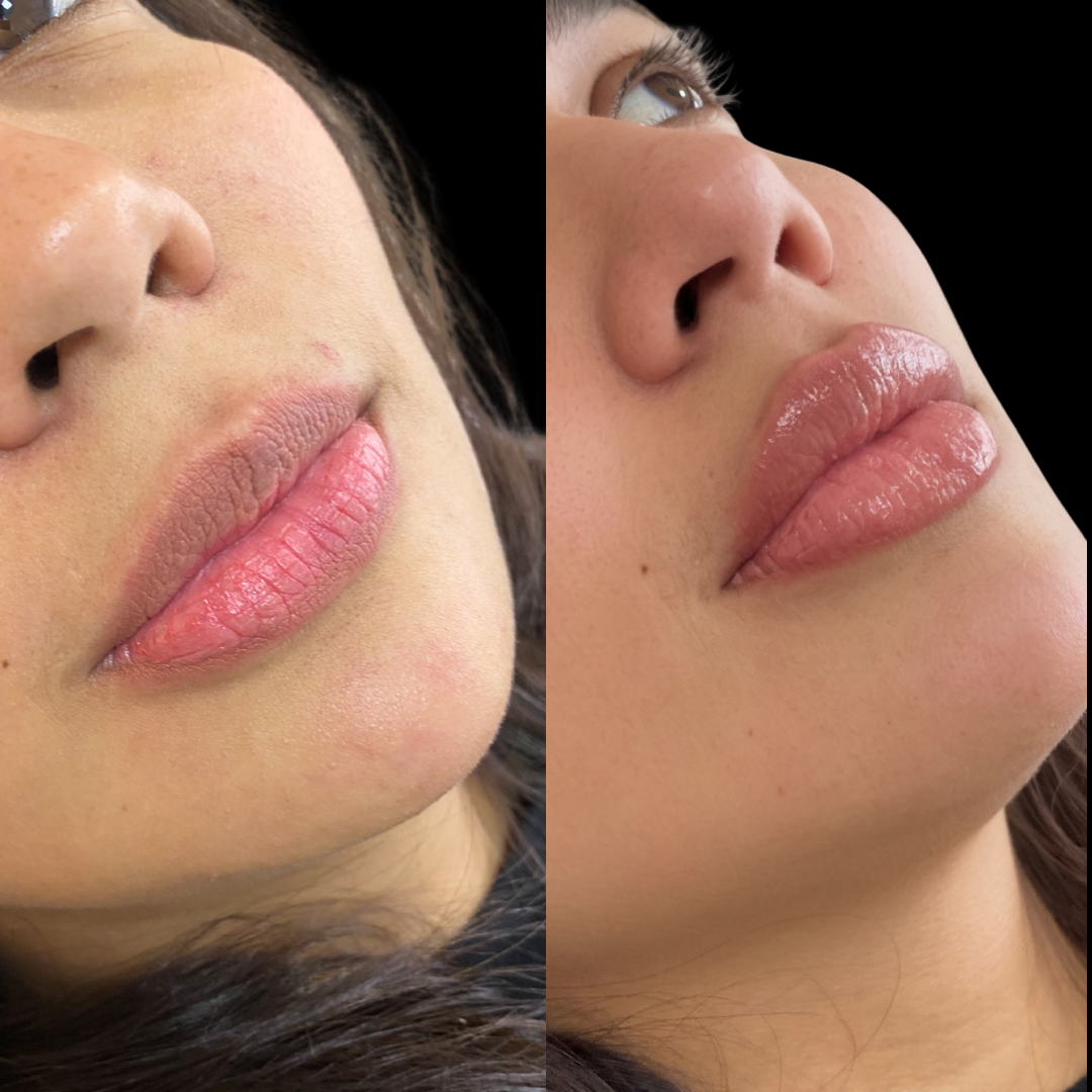 Caso de harmonização facial 6