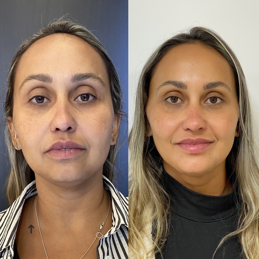Caso de harmonização facial 7